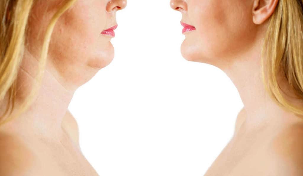 Double Chin treatment Brompton before and after results