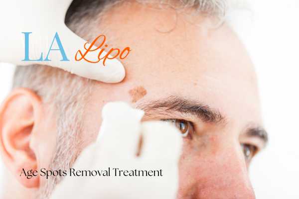 What Are the Most Effective Treatments for Age Spots Brompton?