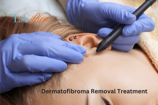 Dermatofibroma Removal Treatment Brompton
