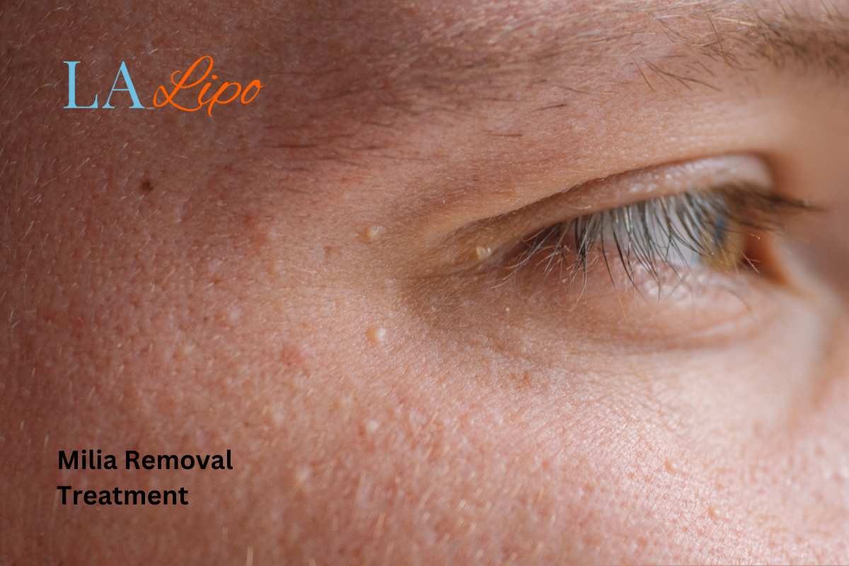 Cryopen Milia Removal: Is It the Easiest and Safest Option Brompton?