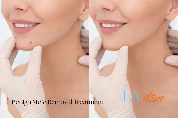 woman's before and after mole removal Brompton results