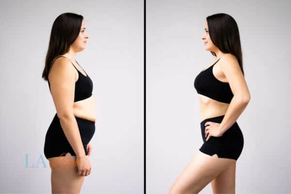 image of woman before and after results of LA-EMS Body Sculpting Brompton to help treat Diastasis recti