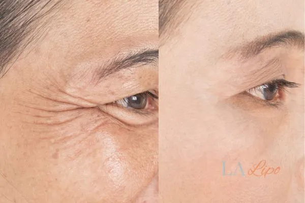Before and after results of woman - HI-fu wrinkles reduction treatment Brompton
