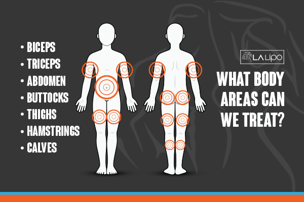 Graphic to show areas you can have LA-EMS Body Sculpting Brompton treatment.