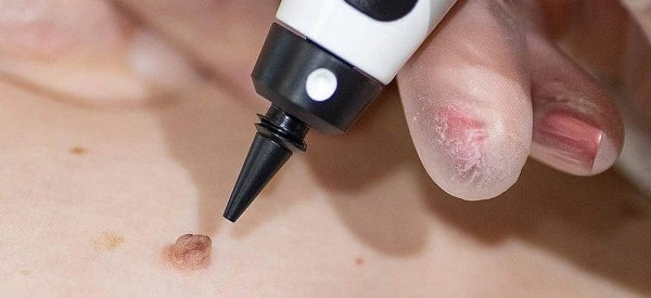 skin tag removal using cryopen Brompton