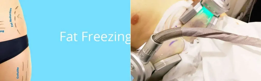 Fat freezing Brompton on multiple areas of the body