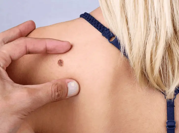 woman having mole removal Brompton consultation before treatment.