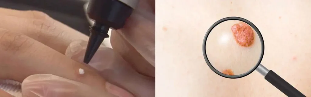 Cryopen for mole removal Brompton - speak to our team today!