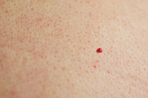 close up of a cherry angioma Brompton
