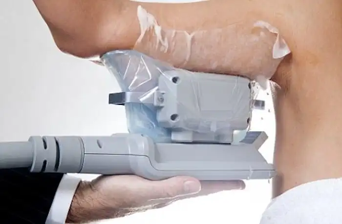 Picture of fat freezing Brompton on the upper arms.