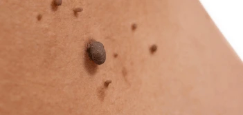 image of a skin tag Brompton