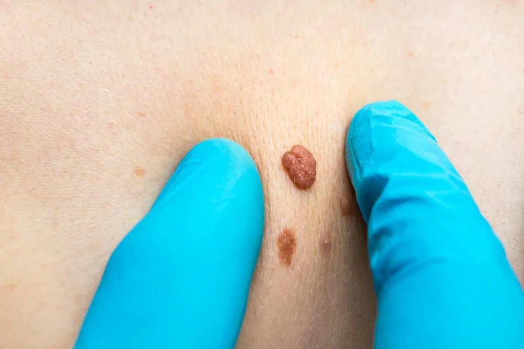 Consultant examining a skin tag Brompton