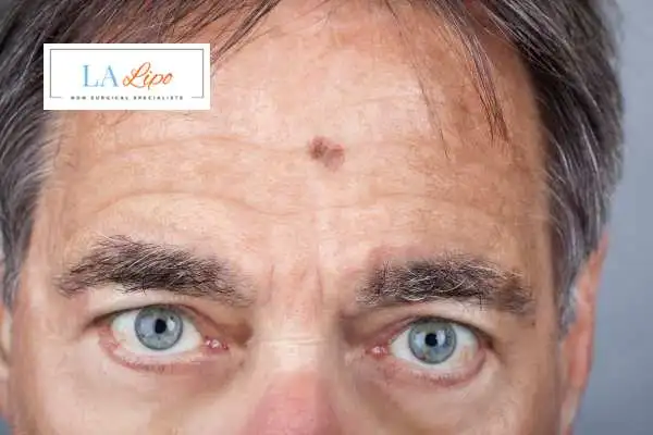Solar Lentigo Removal Brompton image of man with mark on his forehead