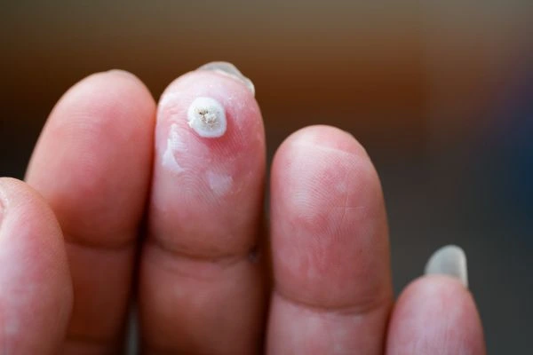 wart on person finger - cryotherapy to treat from LA LIPO Brompton