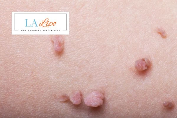 Does cryopen skin tag removal Brompton hurt? Find out now call our team today!