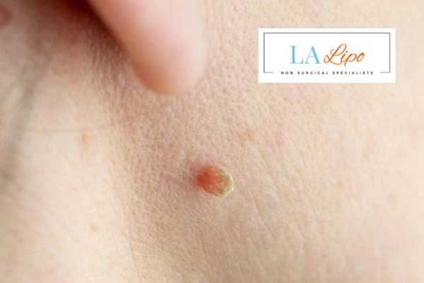 Book skin tag removal Brompton today speak to our team now!