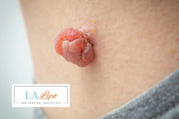 Interested in skin tag removal Brompton? Concerned about the pain? Find out more today!