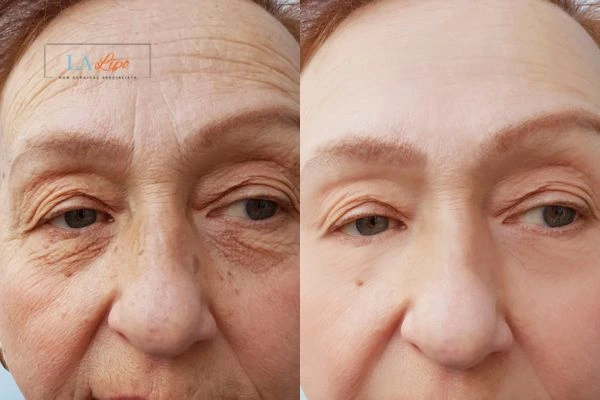The powerful benefits of Morpheus8 Treatment Brompton - Call Our team today!