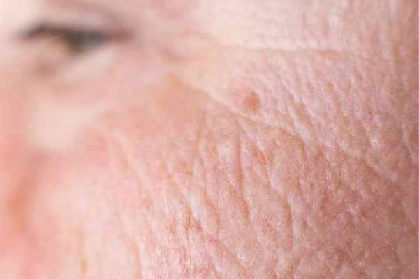 close up picture of a woman's face showing an age spot Brompton