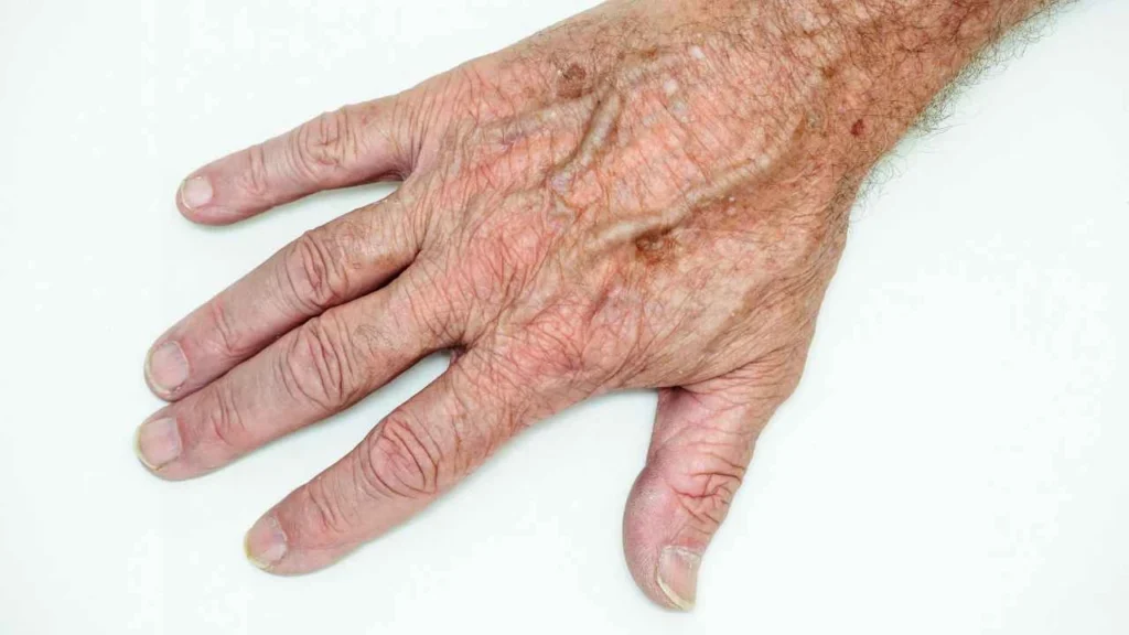 Male hand showing age spot Brompton
