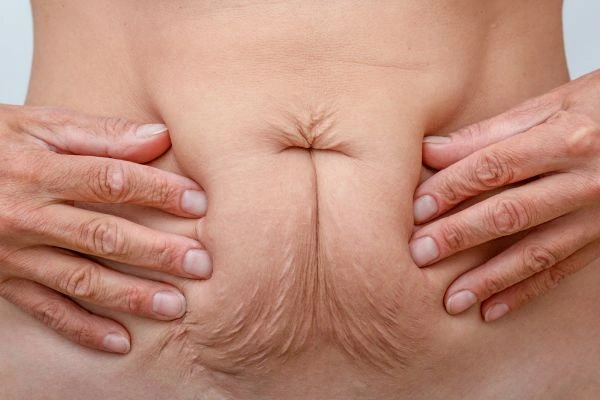 Image of a woman's stomach with loose skin - example of skin tightening Brompton options