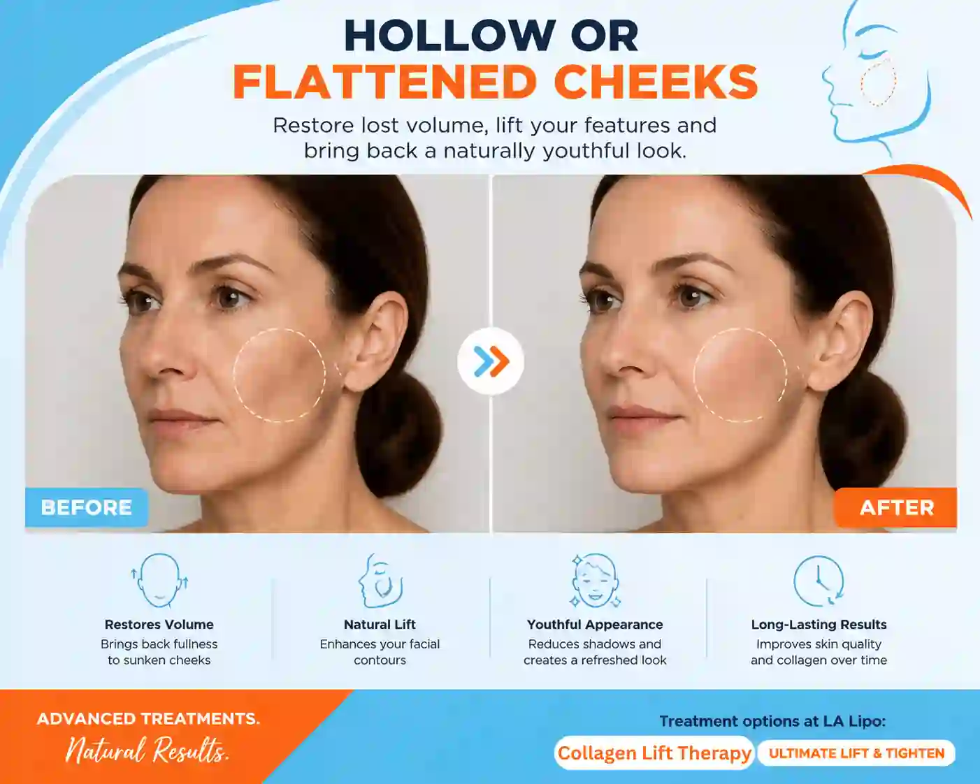 Sign #4: Hollow or Flattened Cheeks Brompton