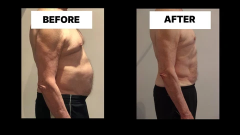 What Symptoms Can Diastasis Recti Cause in Men? Weak Core, Back Pain and Poor Posture Brompton